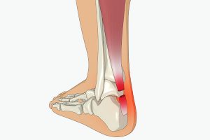 Achilles Tendon Rupture Perth Orthopaedic Specialist Centre