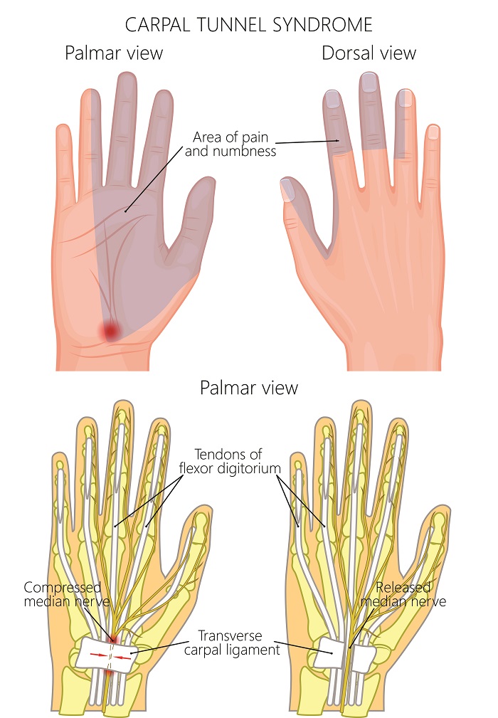 Carpal Tunnel Syndrome - Perth Orthopaedic Specialist Centre