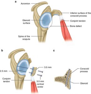 Shoulder Instability – Laterjet Bone Block Procedure (Coracoid Process ...