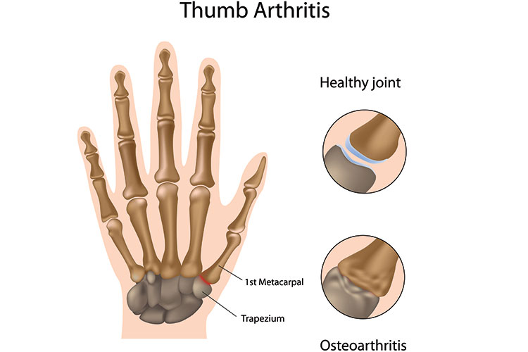 Thumb-Arthritis-2