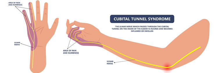 Cubital Tunnel Syndrome (Ulnar nerve compression) - Perth