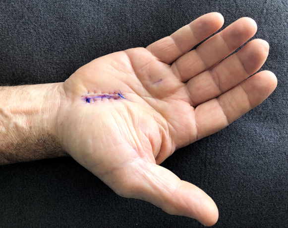 Endoscopic carpal tunnel release surgery - Perth Orthopaedic Specialist  Centre