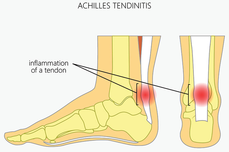 Achilles-tendinitis-posc-1