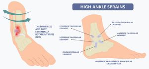 High Ankle Sprain/Syndesmosis Injury - Perth Orthopaedic Specialist Centre