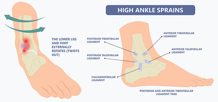 High Ankle Sprain Syndesmosis Injury Perth Orthopaedic Specialist Centre High Ankle Sprain Syndesmosis Injury Perth Orthopaedic Specialist Centre