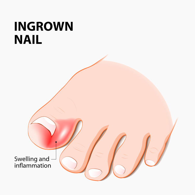 Ingrown Toe Nail Wedge Resection Perth Orthopaedic Specialist Centre