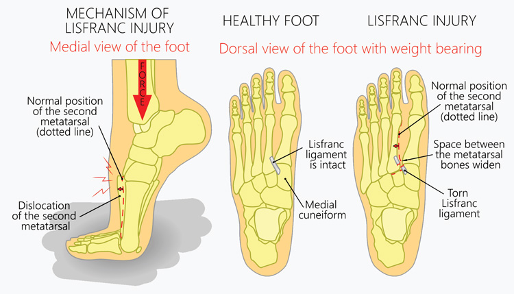 Lis Franc/Midfoot fracture - Perth Orthopaedic Specialist Centre