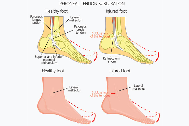 Peroneal-tendon-transfer-1