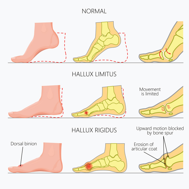 Treatment for Arthritic Big Toe Joints (Hallux Rigidus) - Perth Foot Centre